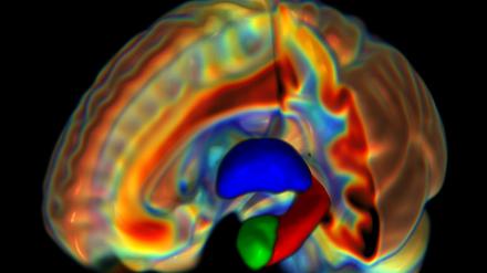 Hirnscan einer Frau mit blau hervorgehobenem Thalamus, der Amygdala (grün) und dem Hippocampus (rot).