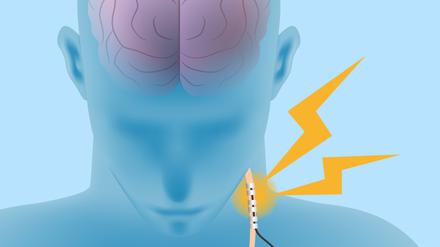 Die Stimulierung des Vagusnervs soll Rheuma lindern. (Symbolbild)