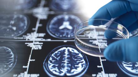 Allein in Deutschland lebten bis Ende des Jahres 2023 rund 1,8 Millionen Menschen mit Demenz. Die häufigste Demenzursache ist die Alzheimer-Erkrankung.