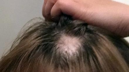 "Bei Haarausfall fühlen sich Männer oft älter und Frauen oft krank". Natalie Garcia Bartels, Dermatologin und Haarforscherin.