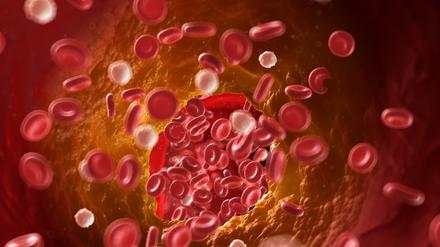 Illustration einer verstopften Arterie.