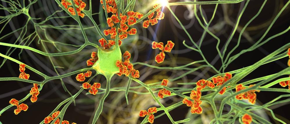 Antikörper greifen Nervenzellen an (Illustration)