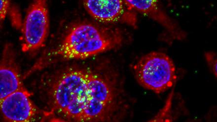 Grün ist hier leider nicht die Hoffnung, sondern das Mikro- und Nanoplastik in den Krebszellen.
