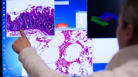 Ein Mitarbeiter zeigt im Institut der Pathologie der Universitätsklinik Charité in Berlin an einem Computerbildschirm auf eine Darstellung einer eingescannten Probe eines Stück Gewebes aus dem Dickdarm, das bei einer Operation entnommen wurde. 