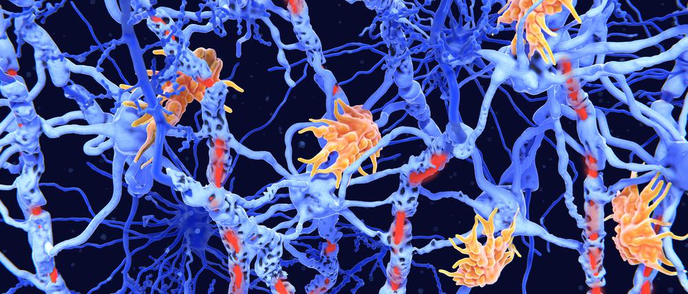 Bei Multipler Sklerose attackieren Immunzellen (orange) die Nervenzellen. (Illustration)