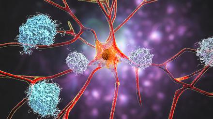 Sieht hübsch aus, ist aber sehr hässlich: Neuronen mit Zeichen der Alzheimerschen Krankheit wie Amyloid Plaques, Tau-Fibrillen und Netzwerkschäden (Illustration).