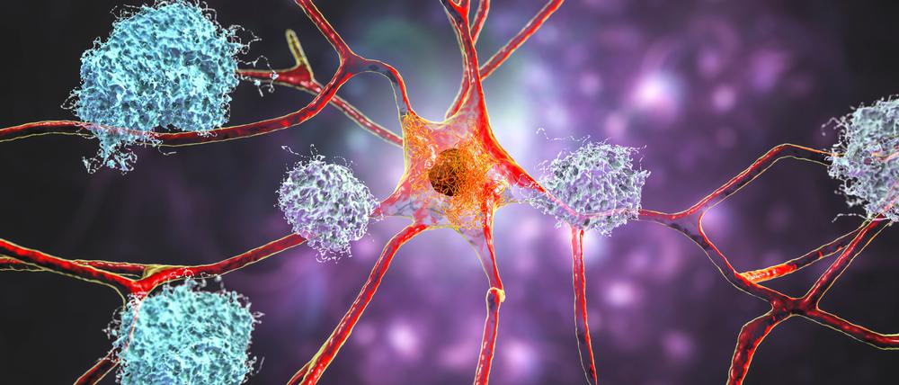 Sieht hübsch aus, ist aber sehr hässlich: Neuronen mit Zeichen der Alzheimerschen Krankheit wie Amyloid Plaques, Tau-Fibrillen und Netzwerkschäden (Illustration).