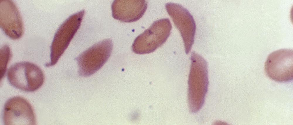 Mikroskopfoto zeigt halbmondförmige rote Blutkörperchen eines an Sichelzellenanämie erkrankten Patienten aus dem Jahr 1972. 