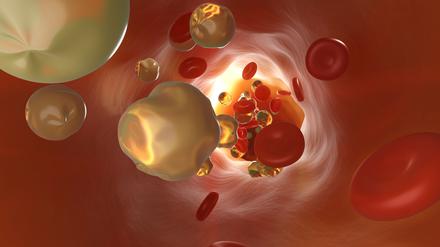 Manche Menschen haben erblich bedingt mehr krankmachende Cholesterin-Partikel im Blut.