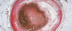 Gefäßschaden. Die mikroskopische Aufnahme zeigt den Querschnitt einer Schlagader (Arterie). Sie wurde durch Verfettung verengt (weißes Material) und schließlich durch einen Blutpfropf (Thrombus) verschlossen.