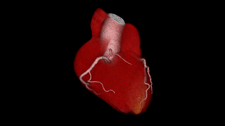 Computertomographen bilden mittlerweile feinste Herzgefäße, hier von Patientin Andrea Tismer, ab. Bestimmte Herzkatheter kann man sich so sparen.