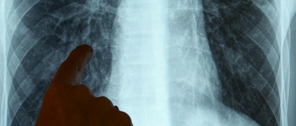 Im Berliner Tuberkulose-Zentrum wird die Röntgenaufnahme eines Patienten ausgewertet. 