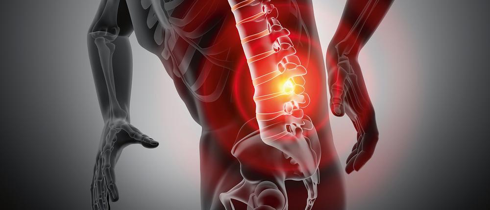 Jährlich erleiden etwa 180.000 Menschen in Deutschland einen Bandscheibenvorfall.