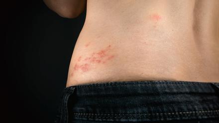Eine Frau leidet unter dem für Gürtelrose typischen Hautausschlag an der Hüfte.