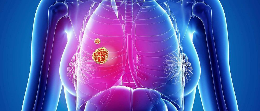 Gefahr in der Lunge. Die grafische Darstellung zeigt zwei Geschwülste in der rechten Lunge.