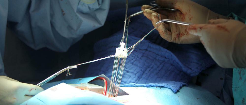 Am offenen Herzen. Hier wird gerade ein Herzklappenersatz eingesetzt.