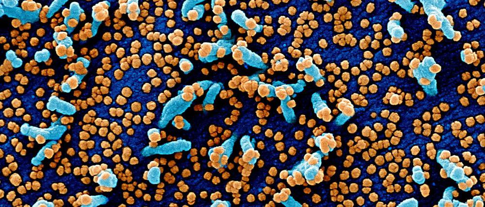 Sars-CoV-2-Viruspartikel (orange) treten aus einer stark infizierten Blutzelle (blau) aus, die einem Patienten entnommen wurde (eingefärbte elektronenmikroskopische Aufnahme).