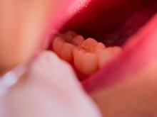 Behandlung endet mit Notoperation: Zahnarzt bohrt in der Türkei versehentlich Schraube in Gehirn von Patient 
