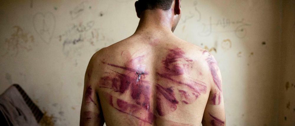 Folterspuren. Ein Syrer zeigt seine Wunden, nachdem das Assad-Regime ihn freiließ. Die Bundesanwaltschaft hat jetzt einen Arzt angeklagt, der für den Diktator Gefangene misshandelt haben soll