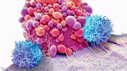 Abwehrkampf: Im Elektronenmikroskop wird sichtbar, wie Immunzellen (blau) eine Krebszelle (rot) attackieren.