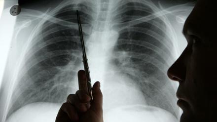 Diagnose Lungenkrebs. EU-Abgeordnete wollen mehr Geld für Forschung. 