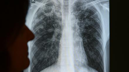 Ein Tuberkulose-Fall in Potsdam ist nun bekannt geworden.
