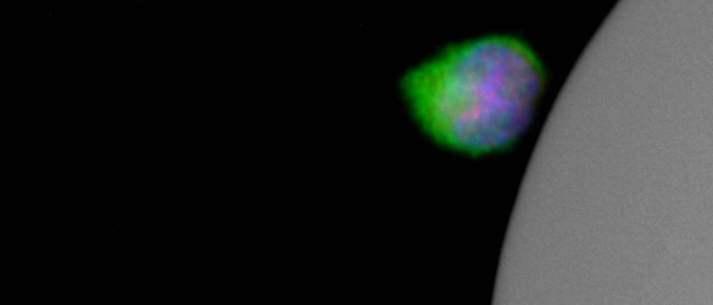 Tumorzellen, die PSA (grüne Färbung) produzieren.